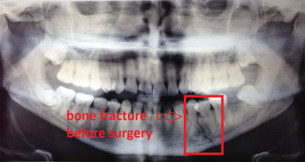 PERIODONTAL EVALUATION IN MAXILLOFACIAL AND MANDIBULAR TRAUMA: ARCH BAR - Dr. STEFANO BREZZO Odontoiatra